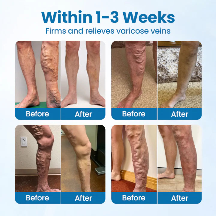 Natravor® VeinGuard Herbal Spray-✅ Clinically proven to eliminate varicose veins in just 7 days!