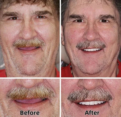 ✅Natravor™-Advanced Custom-Fit Functional Dentures