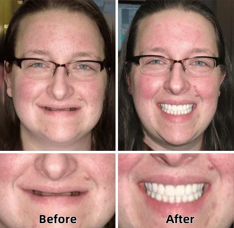 ✅Natravor™-Advanced Custom-Fit Functional Dentures