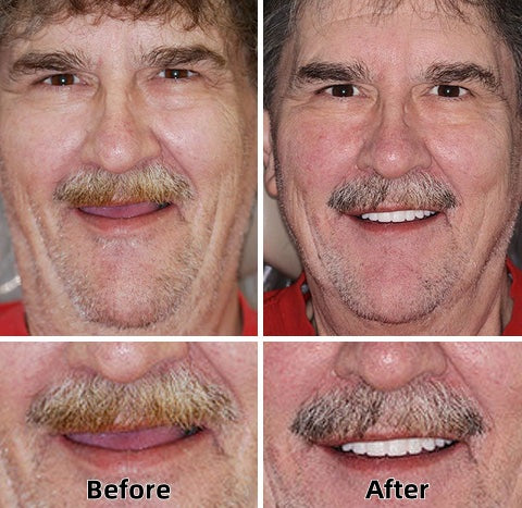 ✅Natravor™-Advanced Custom-Fit Functional Dentures