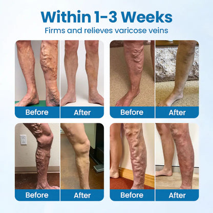 Natravor® VeinGuard Herbal Spray-✅ Clinically proven to eliminate varicose veins in just 7 days!