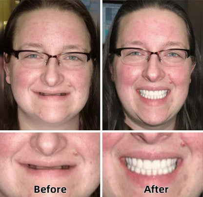 Natravor™-Advanced Custom-Fit Functional Dentures